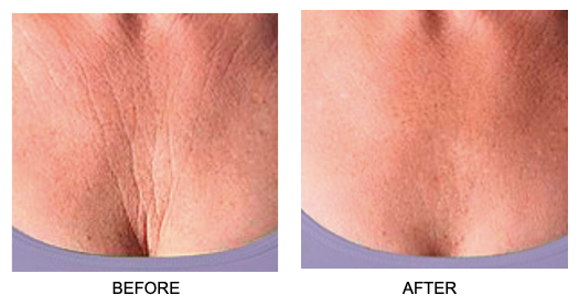 Skin Plumping Reusable Chest Pad | Dreambox Beauty