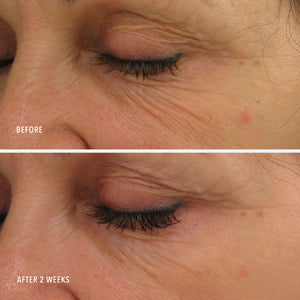 Close-up comparison of a woman's eye area showing visible reduction in wrinkles and fine lines after two weeks of using Power Lift | HydroPeptide skincare serum.