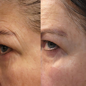 Close-up comparison showing reduced wrinkles and improved skin texture around the eye after using Complete Serum | Skin Authority, highlighting skincare effectiveness.