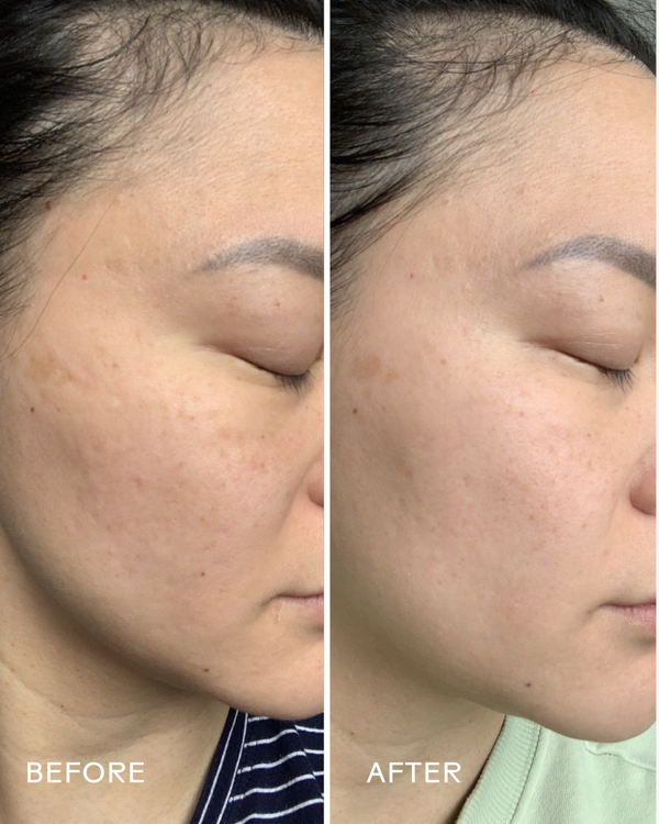 Before and after comparison showing improved skin texture and reduced blemishes on a woman's cheek after using Glow 49% Jojoba Oil Serum | Three Ships, highlighting skincare benefits.