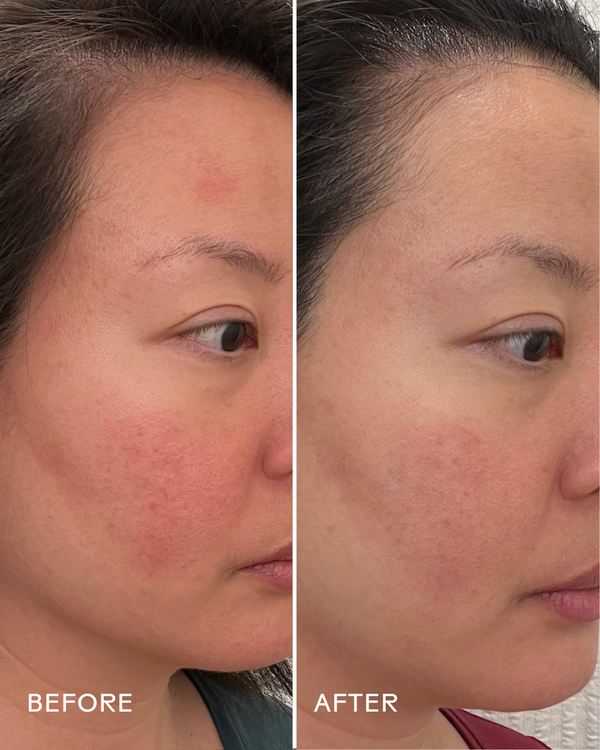 Comparison of a woman's cheek showing reduced redness and smoother skin after using Replenish Ceramides + Blueberry Barrier Repair Serum | Three Ships for skincare improvement.