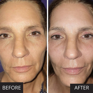 Before and after comparison of a woman's face showing improved skin texture and reduced wrinkles using the MyoLift™ MD Microcurrent Facial Professional Device | 7e Wellness.