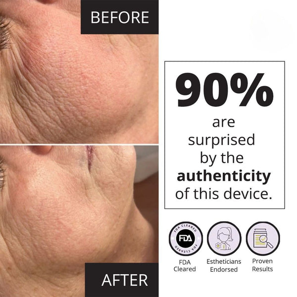 Close-up comparison of a person's cheek and jawline before and after using the MyoLift Mini Microcurrent Facial Device | 7e Wellness, showing visible skin smoothing and wrinkle reduction.