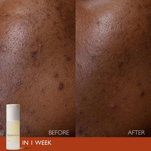 Close-up comparison of skin showing improved texture and reduced blemishes after one week of using Elixir | Omorovicza skincare product.
