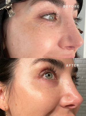 Before and after close-up comparison of a woman's eye area showing reduced wrinkles and smoother skin, highlighting the effects of SiliconeFusion™ Eyes & Mouth Patches | Dermaclara in skincare and wellness.