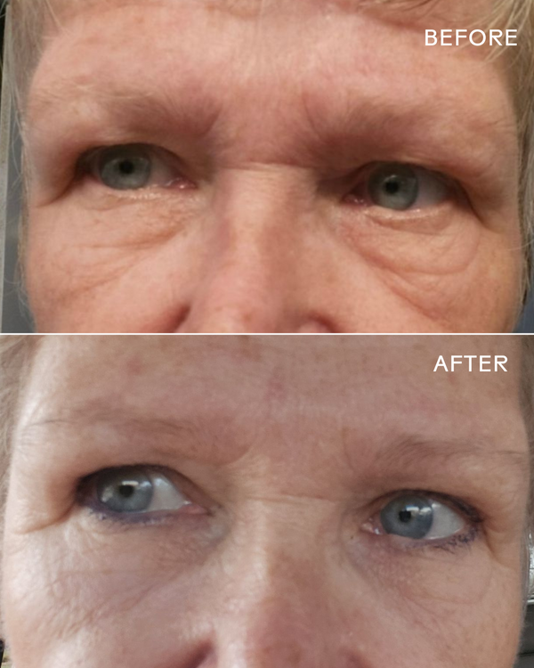 Comparison of a woman's eye area before and after using EyeHero™ Bio-Retinol Smoothing Eye Cream | Three Ships, showing visible reduction in wrinkles and smoother skin texture.