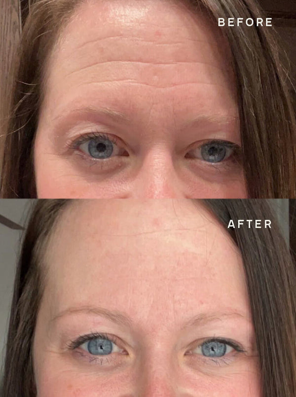 Close-up comparison of a woman's forehead before and after using SiliconeFusion™ Forehead Patch | Dermaclara, showing reduced wrinkles and smoother skin for enhanced skincare results.