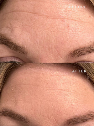 Close-up before and after image showing reduced forehead wrinkles and smoother skin texture after using SiliconeFusion™ Forehead Patch | Dermaclara for skincare improvement.