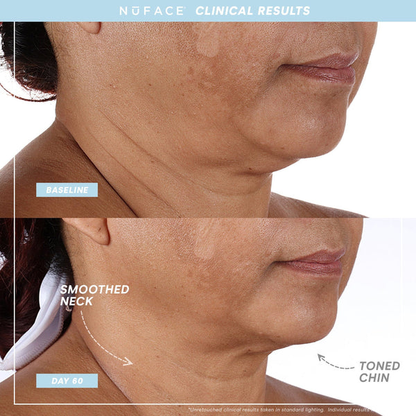 Before and after comparison showing skin improvement on a woman’s neck and chin after 60 days using Trinity+ Pro | NuFACE, highlighting smoother neck and toned chin results.