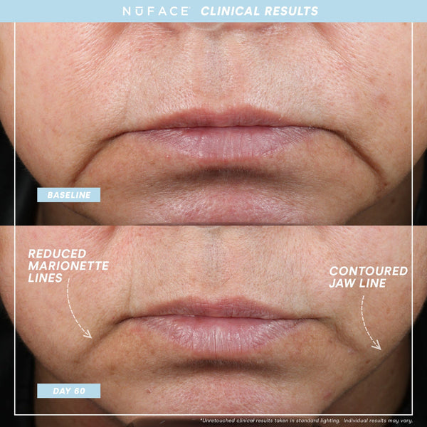 Close-up comparison of lower face showing reduced marionette lines and a more contoured jaw line after 60 days of using Trinity+ Pro | NuFACE skincare device.