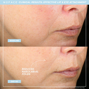 Close-up before and after comparison showing reduced nasolabial folds on a woman's face after 60 days of using TRINITY+ Effective Lip & Eye Attachment | NuFACE for skincare and facial wellness.