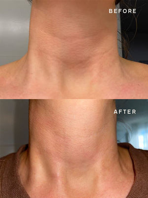 Before and after comparison showing reduced neck wrinkles and smoother skin texture after using SiliconeFusion™ Neck Patch | Dermaclara for skincare and body care.