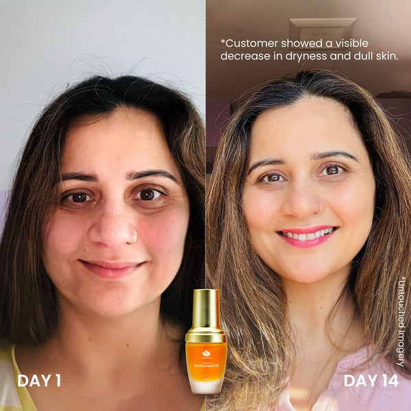 Before and after comparison of a woman’s face showing improvement in skin hydration and brightness after 14 days using Timeless Kumkumadi Oil | Shankara, with visible reduction in dryness and dullness.