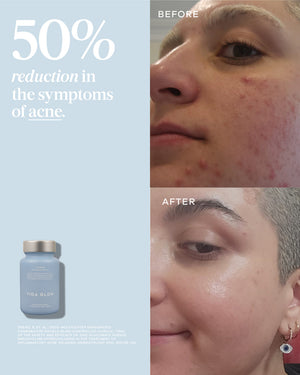 Before and after comparison showing a noticeable 50% reduction in acne symptoms on a person's face, alongside a bottle of Clear Capsules | VIDA GLOW skincare supplement.