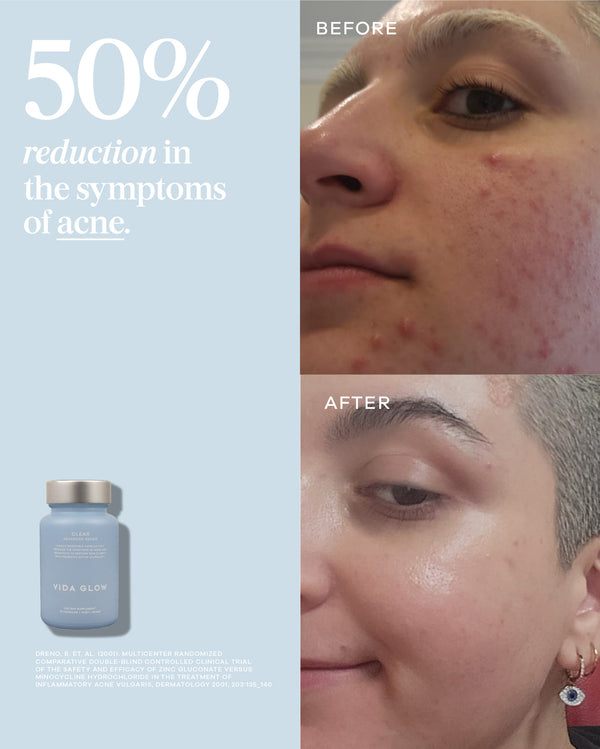 Before and after comparison showing a noticeable 50% reduction in acne symptoms on a person's face, alongside a bottle of Clear Capsules | VIDA GLOW skincare supplement.