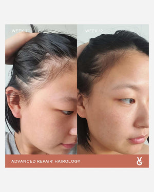Before and after comparison showing hair growth progress over 12 weeks using Hairology Capsules | VIDA GLOW, highlighting improved scalp health and thicker hair.