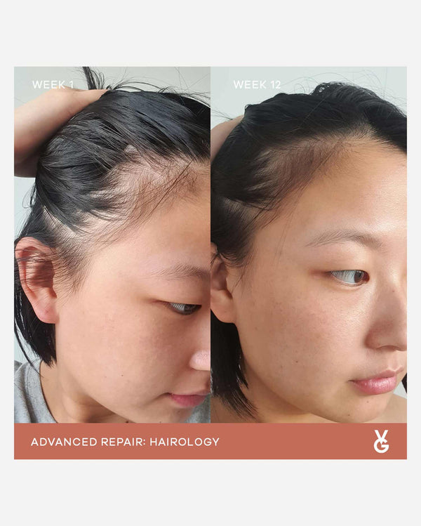 Before and after comparison showing hair growth progress over 12 weeks using Hairology Capsules | VIDA GLOW, highlighting improved scalp health and thicker hair.