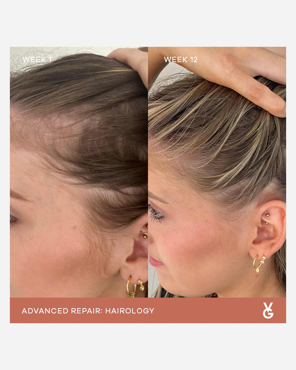 Side-by-side close-up comparison of a woman's hairline showing visible improvement in hair growth from week 1 to week 12 after using Hairology Capsules | VIDA GLOW.
