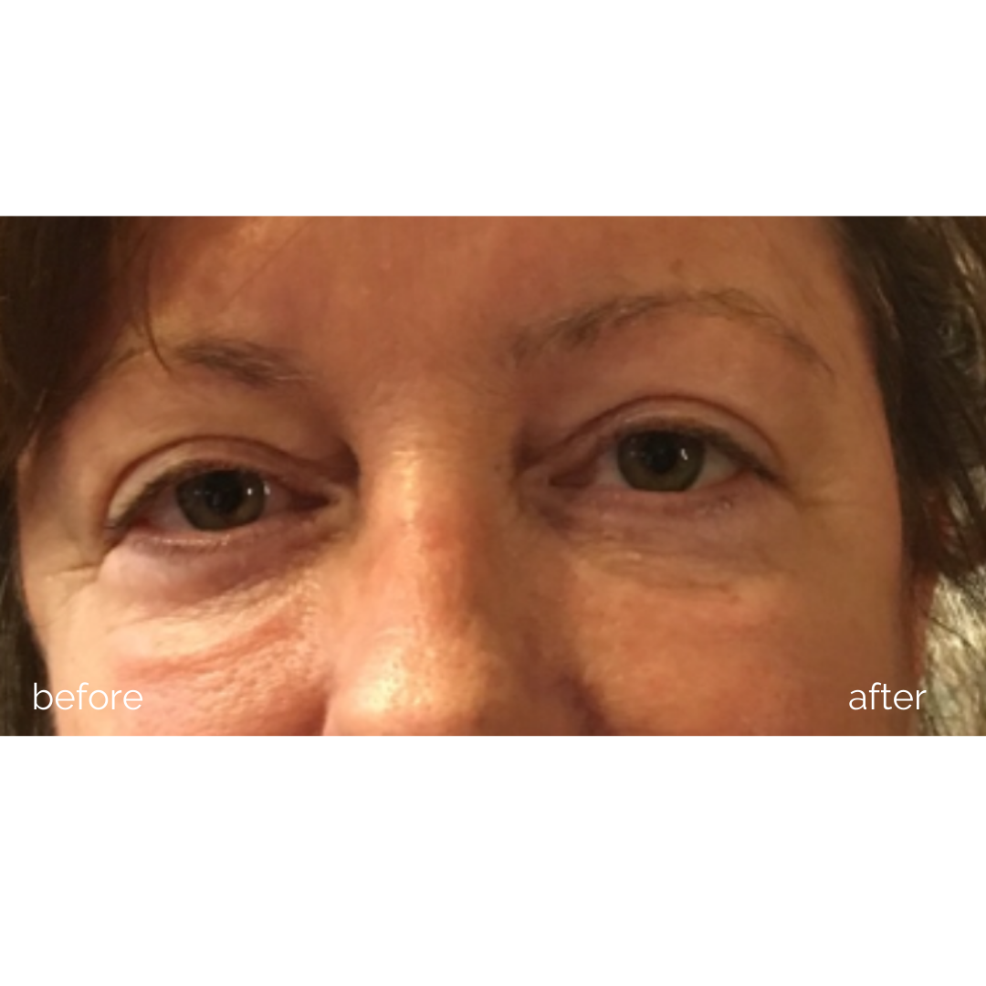 Eye Rejuvenation | MBK Skincare