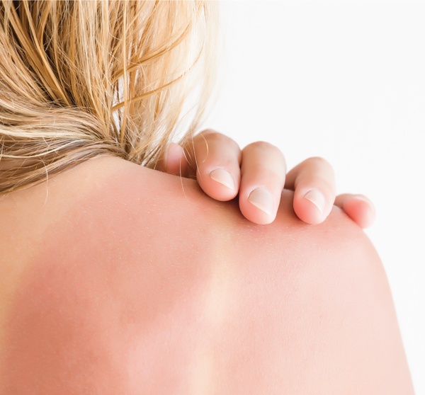 Close-up of a person with sunburned skin on the shoulder gently touching the irritated area, highlighting the need for Ahhhsome Relief™ Foam-to-Oil After Sun Body Mousse | Farmhouse Fresh in skincare and body care.