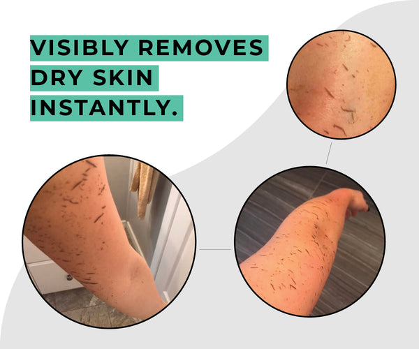 Deep Exfoliating Body Scrub Mitt | Dermasuri shown removing dry skin flakes from arms with close-up views demonstrating instant exfoliation and improved skin texture.