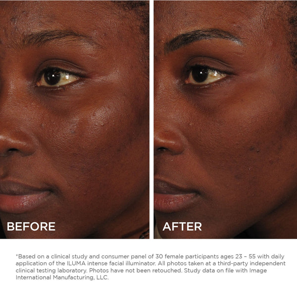 Close-up side-by-side comparison of a woman's face before and after using ILUMA intense facial illuminator | IMAGE Skincare, showing improved skin tone and smoother texture.