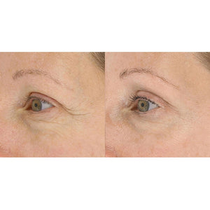 Close-up before and after comparison showing reduced wrinkles and smoother skin around the eye area after using LightStim For Wrinkles | LightStim skincare device.